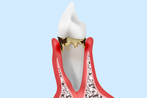 歯肉炎中程度～重症