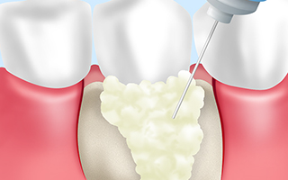 歯周組織再生治療（エムドゲイン法）