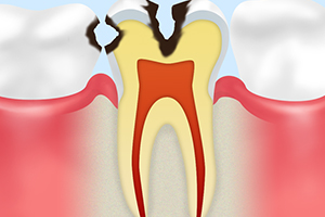 C2【象牙質の虫歯】