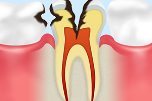 C3【神経まで達した虫歯】