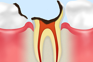 C4【歯根まで達した虫歯】